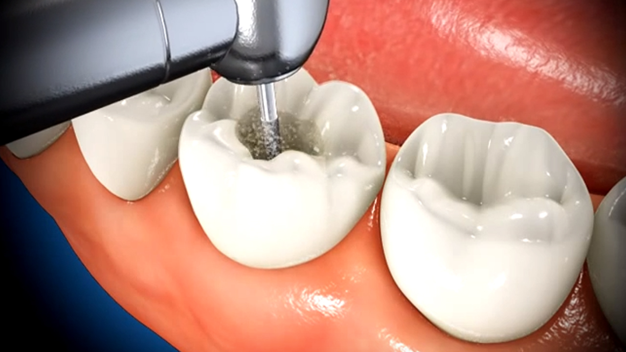 Crown Lengthening: Enhancing Dental Health and Aesthetics
